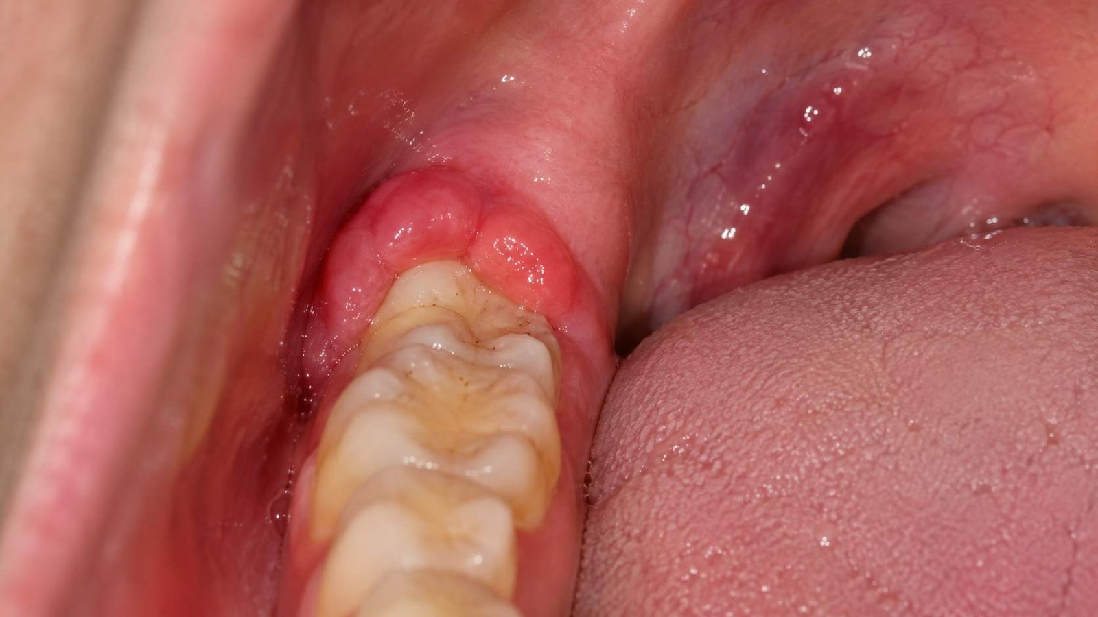 How To Treat Swollen Gums In Back Of Mouth