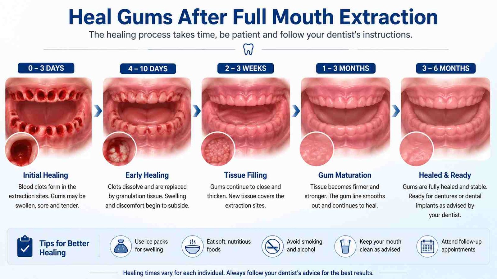What Helps Heal Gums After Full Mouth Extraction